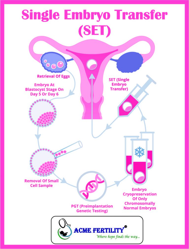 Single Embryo Transfer (SET) – IVF Blogs