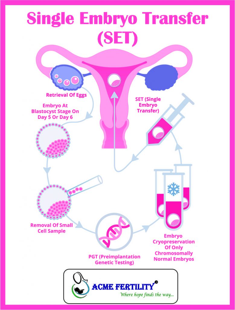 Single Embryo Transfer (SET) IVF Blogs