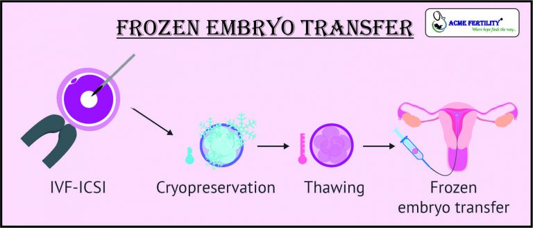 Frozen Embryo Transfer – IVF Blogs