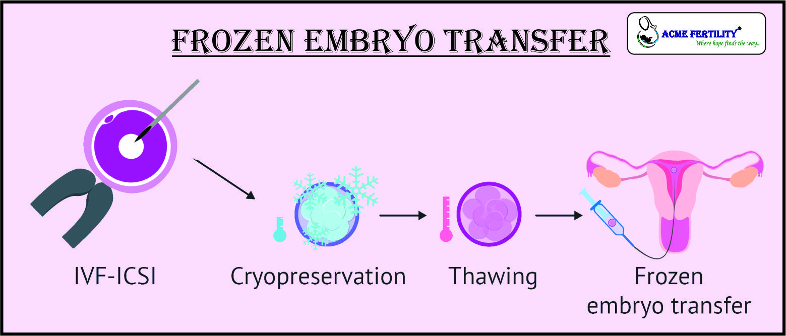 Frozen Embryo Transfer IVF Blogs